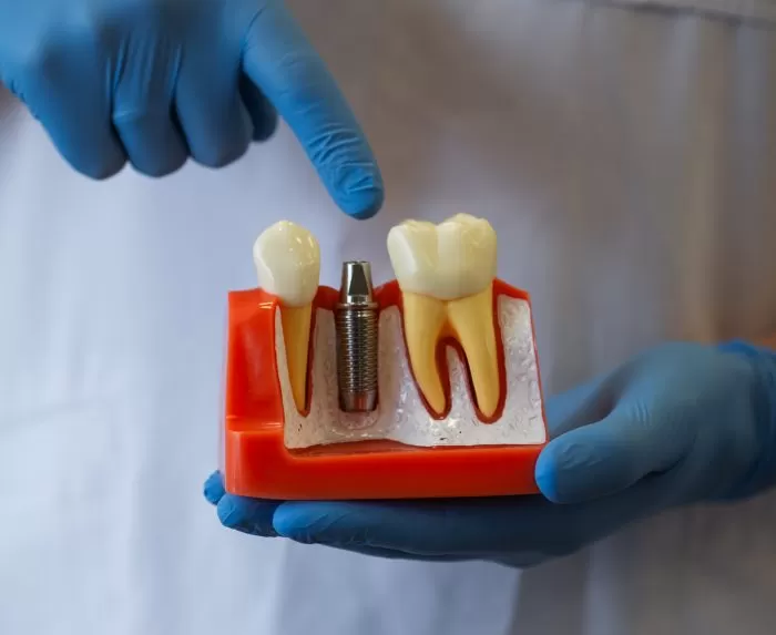 Имплантация под ключ