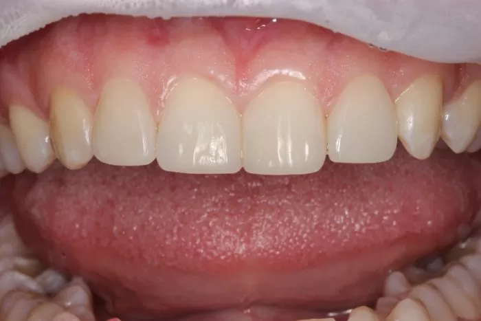 Фото после процедуры