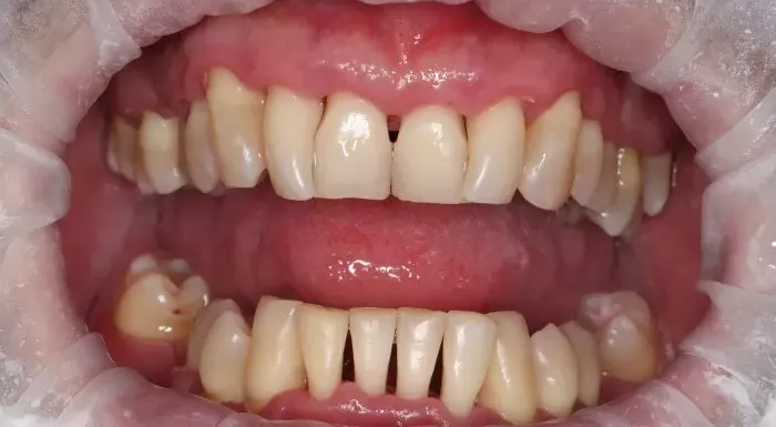 Фото после процедуры