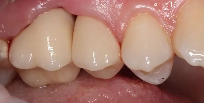 Фото после процедуры