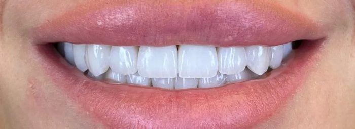 Фото после процедуры