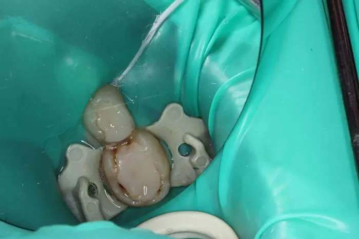 Фото до процедуры