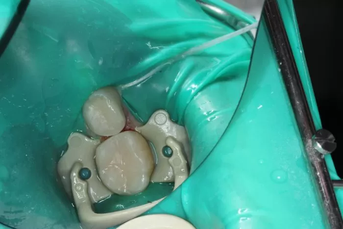 Фото после процедуры