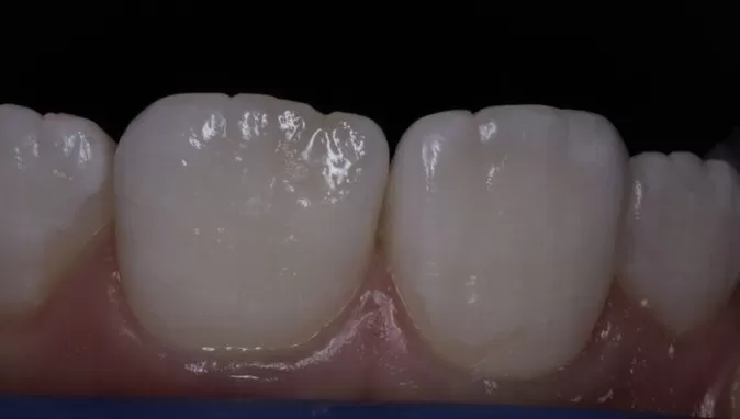 Фото после процедуры