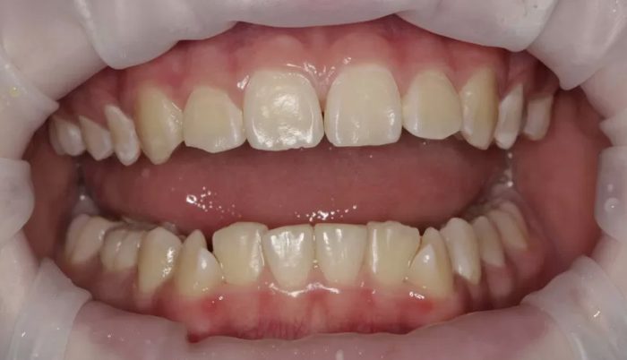 Фото после процедуры