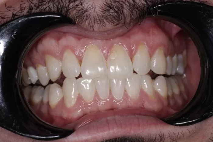 Фото после процедуры